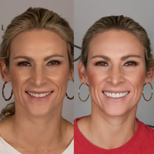 Full_Face_Before_and_After